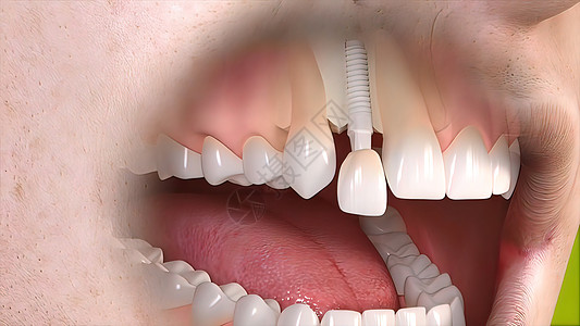 牙科移植手术磨牙插图植入物制品假牙解剖学搪瓷外科药品治疗图片