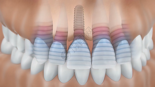 牙科移植手术陶瓷外科安装牙医推介会凹痕插图牙龈矫正解剖学图片