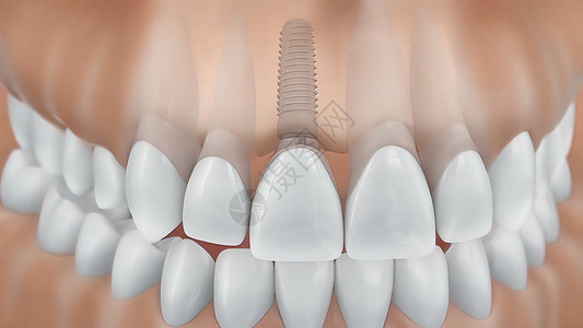 牙科移植手术治疗凹痕注射牙龈口腔科外科推介会安装风俗组装图片