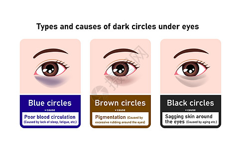 眼下暗环的种类和原因 矢量说明图片