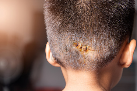 头部撕裂缝合伤口尼龙线缝合约3针医院痛苦维修孩子们岩石伤害治疗创伤外科皮肤图片