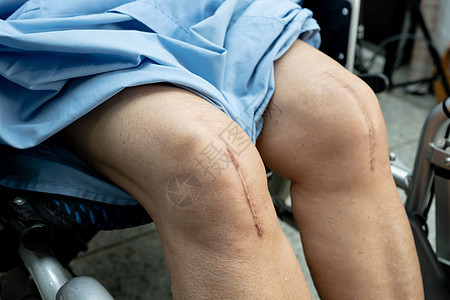 亚洲老年或老年老太太妇女病人在护理医院病房的床上展示她的疤痕手术全膝关节置换缝合伤口手术关节成形术 健康强大的医疗理念金属痛苦切图片