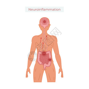 肠道健康不佳导致神经发光矢量说明身体肠子疾病信息插图医疗药品图表解剖学胆量图片
