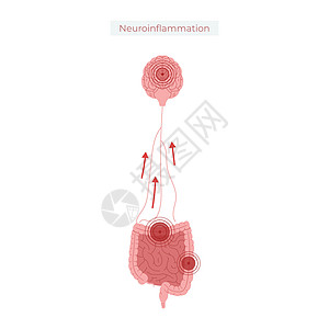 肠道健康不佳导致神经发光矢量说明胆量插图药品肠子信息图表解剖学冒号医疗疾病图片