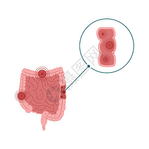 白色背景上孤立的炎食性肠内肠疾病病媒演示说明信息消化冒号直肠侵蚀医疗溃疡结肠炎癌症图表图片