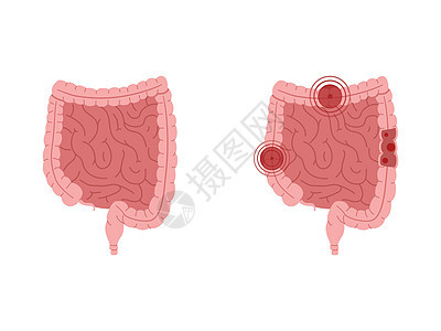 健康肠胃和有炎症的肠胃的平方矢量说明 (单位 百万分之一)图片