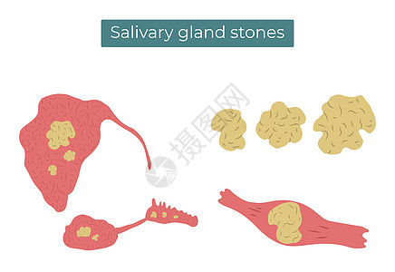 以矢量平方显示在 亚管和亚语言的盐状腺和管道中的石块图片