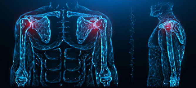 肩关节疼痛的多边形矢量图解 肩关节疾病 人体肌肉骨骼系统疾病图片