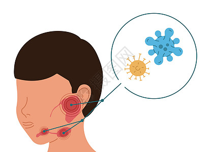 患有唾液腺病毒发炎的人 用矢量说明硅叶丝虫病图片