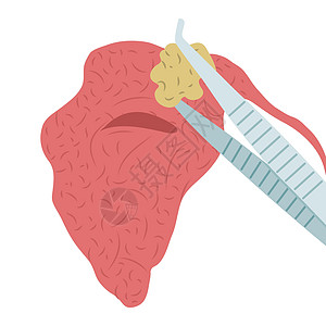 将一块石头从盐酸盐的流利腺中除去的矢量插图图片