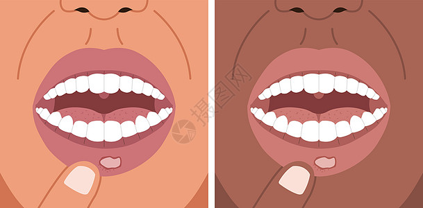 矢量插图 罐头酸痛 嘴唇有方形溃疡 口炎图片