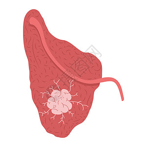 脑瘤在酸盐的唾液腺上 医学病媒图解图片