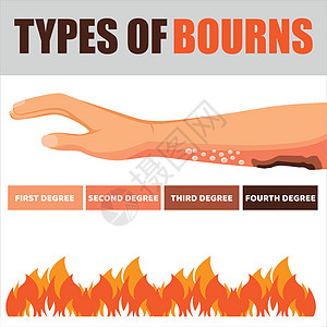 皮肤烧伤处理和相片人口统计学 火灾损害 红皮肤 卡通风格的孤立矢量插图背景图片