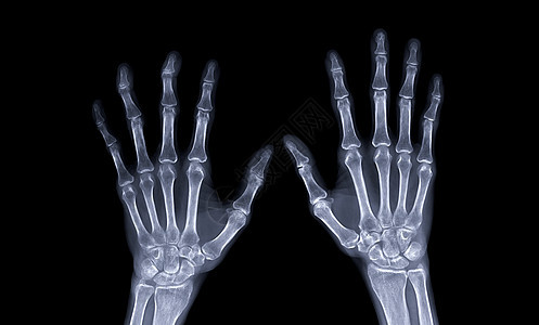 两只手的AP视图的X射线图像 在用于诊断风湿类的黑色背景上被隔离图片