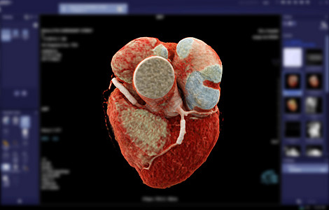 CTA 冠动脉3D剖面图像 以查找冠动脉疾病图片