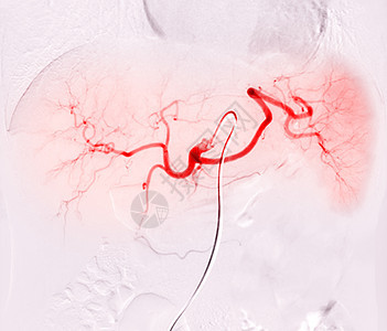 TOCE或Chemoembor化的X光图像是一种程序 允许将剂量的化疗药物直接注射到活性肿瘤或HCC图片
