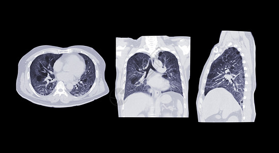 收集肺部感染胸腔或肺轴 日冕和外形的CT扫描器 对肺部感染进行盘点-19 地面玻璃不透明性隔绝在黑色背景上图片