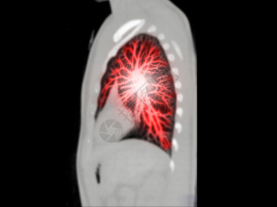 CT 诊断性肺癌 肺结核和大肠杆菌19的剖腹产MIP观察扫描仪解剖学主动脉医院ct船只射线病人3d渲染图片