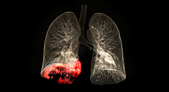 胸部或肺部3D成像的CT扫描显示 在与黑背景隔离的右下额叶地区有19个肺部感染背景