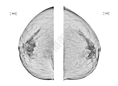 射线数字乳房 X 光检查或乳房 X 光检查两侧乳房 CC 视图用于诊断女性乳腺癌病人检测生长外科医院药品手术预防女士照片图片