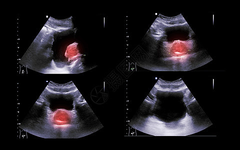 用于检查肾脏和膀胱疾病的尿囊或库布的超声波肾上腺皮层器官腹部超声病人乳突考试调查技术图片