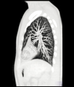 CT 诊断性肺癌 肺结核和大肠杆菌19的剖腹产MIP观察胸部医院断层射线主动脉解剖学渲染检查扫描科学图片