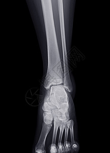 脚踝关节X光图像 用于诊断骨折和纤维骨医院考试外科腓骨诊所疼痛病人胫骨疾病腿痛图片