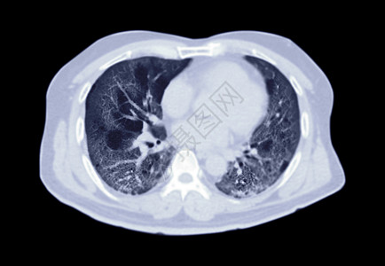 CT扫描胸腔或肺轴对肺部感染的直观观察 共诊19次 地面玻璃不透明在黑色背景中隔离 切片路径图片