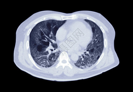 CT扫描胸腔或肺轴对肺部感染的直观观察 共诊19次 地面玻璃不透明在黑色背景中隔离 切片路径背景图片