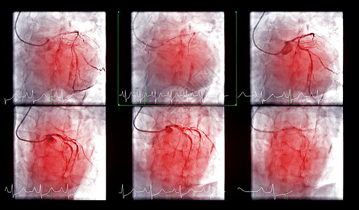 心脏导管化是一种测试 用来检测心跳停止心导管术疾病心血管胸部扫描疼痛心脏病学情况攻击诊断图片