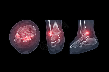 脚踝关节CT扫描显示脚踝关节骨折图片