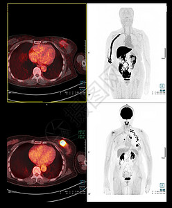 PET 扫描整个人体的图像癌症冠冕胸部图片