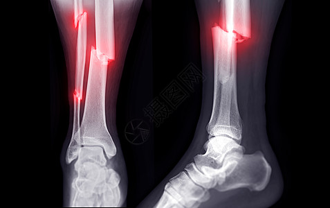 脚踝关节X光图像显示有骨折的蒂比亚骨折和纤维骨骼骨折医院盘子绷带膝盖诊所疼痛电影诊断腓骨解剖学图片