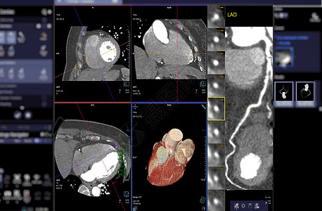 CTA 冠动脉3D在屏幕上显示图像 以诊断船只冠动脉衰竭检查解剖学心脏病学动脉瘤放射科医院疾病器官3d动脉图片