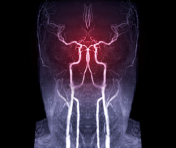 用于评价脑动脉 心电图 神经衰竭和中风病的脑动脉MRA或磁共振血管学图片