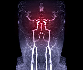 用于评价脑动脉 心电图 神经衰竭和中风病的脑动脉MRA或磁共振血管学图片