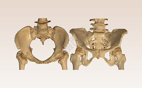 CT 骨盆骨骼扫描与臀部连接3D成像插件和输出视图图片