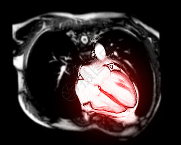 MRI心脏或心脏垂直轴视图磁共振成像(MRI)显示4个心脏室 用于诊断心血管疾病 3图片