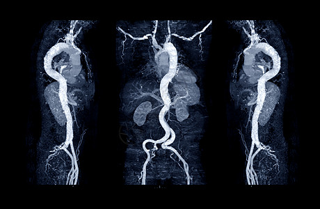 使用曲线 MPR 技术显示腹主动脉和左 右髂动脉显示主动脉夹层的 CTA 主动脉集合图片