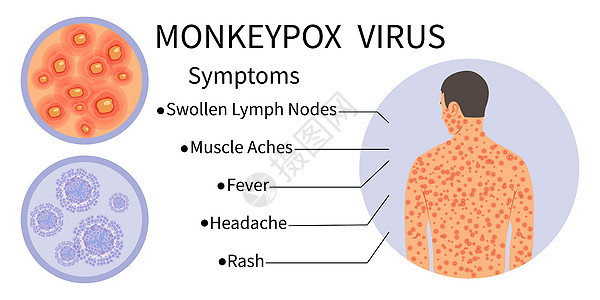 提高症状意识的猴子病毒横幅图片