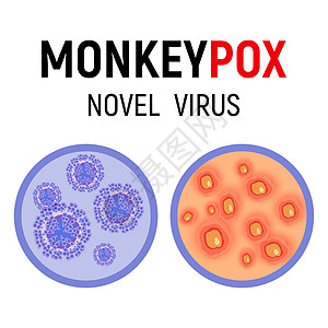 猴天花病毒细胞和有皮疹的人类皮肤图片