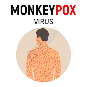 一个身上满是皮疹的猴子天花的男人图片