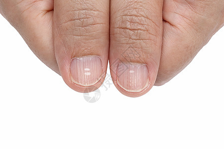指甲上白斑和垂直脊的指甲症状 缺乏维生素和矿物质饮食白色指甲油乐队线条手指食品疾病矿物图片