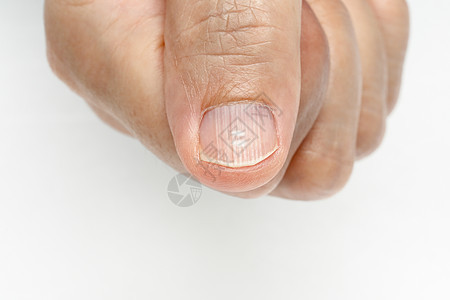 指甲上白斑和垂直脊的指甲症状 缺乏维生素和矿物质指甲油矿物线条乐队饮食手指疾病食品白色图片