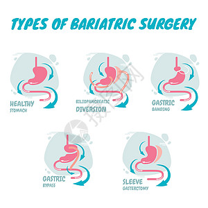 减肥手术的类型 它是胃消化系统的过程 一种新型的减肥手术图片