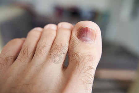一个脚趾受伤 一个重物体掉在指甲下的血肿 伤痕损伤伤口痛苦事故出血身体皮肤病变创伤真菌图片