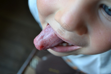 孩子被咬的舌头宏观牙科男生感染痛苦语言水疱手术卫生婴儿图片