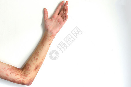 治疗感染的外皮性皮炎和对女性手臂的痒痒 需要进行药物治疗图片