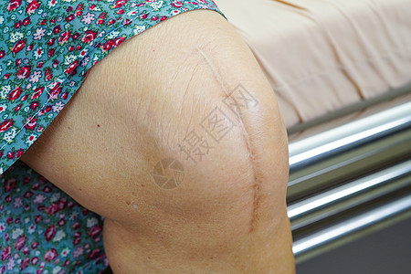 患有伤疤替代膝盖手术的亚裔老年妇女在医院接受治疗解剖学成人纤维疾病外科皮肤女士情况护理药品图片
