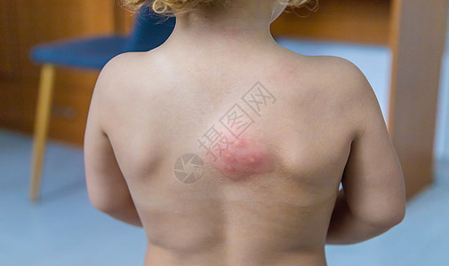 蚊子咬回一个孩子 有选择的焦点身体女孩横幅昆虫感染病人划痕疾病皮肤科伤口图片